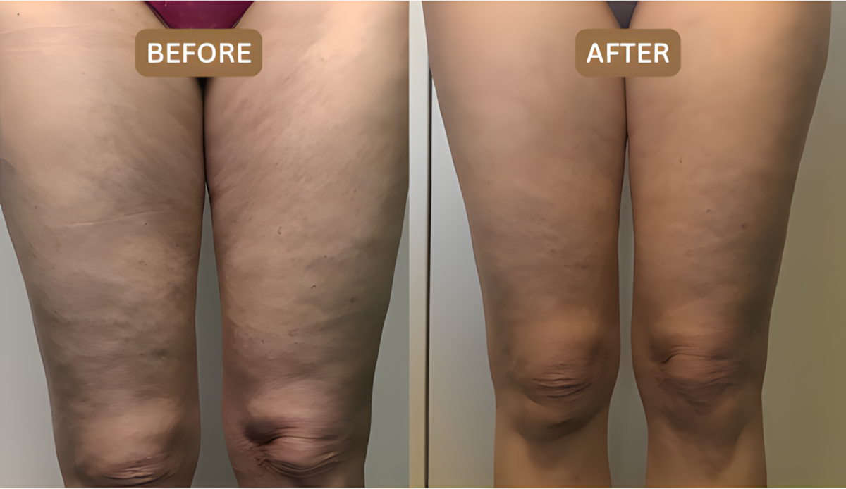 Merova - Anti Cellulite Massage Oil